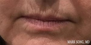 Before and After image of Lip Augmentation