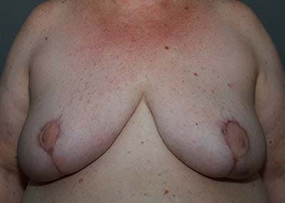 Breast Reduction Before & After Gallery - Patient 121669553 - Image 2